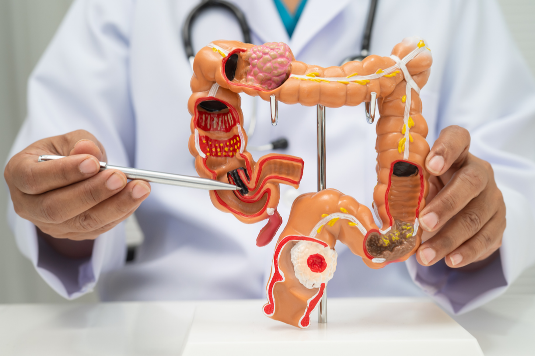 Inflammatory Bowel Disease
